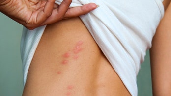 Best care for bug bites: Doctors share treatment tips for minor and severe bites