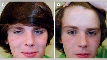 How Justin Bieber's bangs could save teens' skin