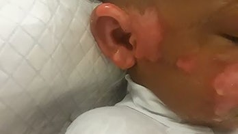 Boy, 7, severely burned after being doused with nail polish remover, set on fire, mom says