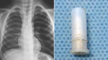 Boy's squeaky cough caused by whistle stuck in his throat