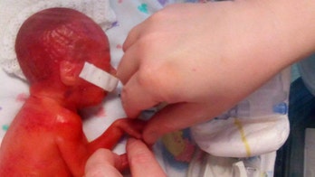 Premature baby was so underdeveloped her brain was showing through her skin