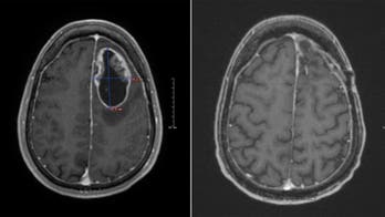 Dad battling brain cancer shows no sign of tumor regrowth after clinical trial