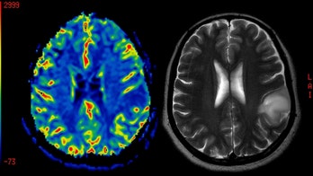 Study finds radiation harms memory, speech in brain cancer patients