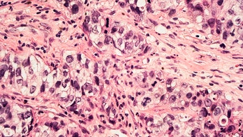 Breast cancer treatments vary widely in cost and complications