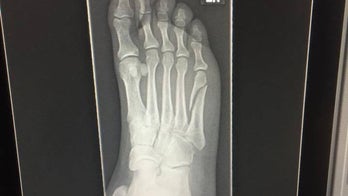 Patriots fan breaks foot while celebrating Super Bowl win