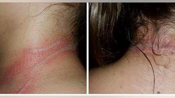 Freak accident with cellphone leaves teen with second-degree burns on neck