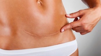 Woman hits back at critics who think her C-section offered a 'convenient' birth