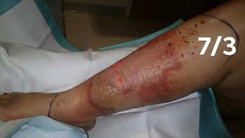 North Carolina woman claims she nearly lost leg after contracting serious infection from pedicure