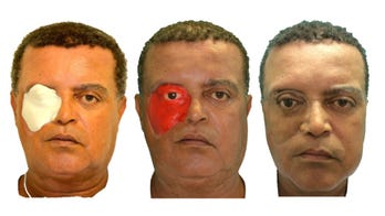 Cancer survivor receives world's first 3-D printed face prosthesis