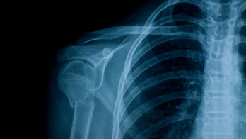 FDA approves generic Boniva for osteoporosis