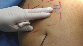 One-time treatment gets rid of cellulite