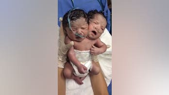 Rare baby born with 2 heads dies