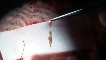 Boy's twitch turned out to be parasite in brain