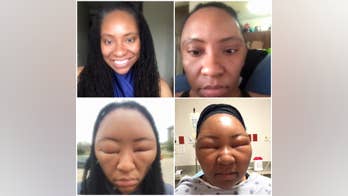 Texas woman's face swells after allergic reaction to hair dye