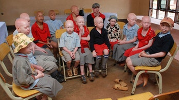US doctors help Tanzanian children harmed in albino attacks