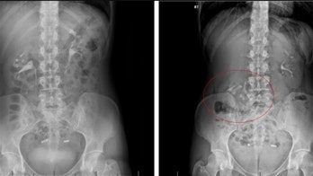 Woman diagnosed with rare 'floating kidney' condition