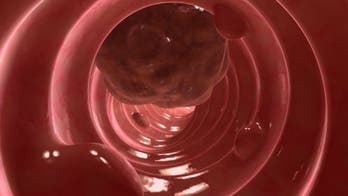 10 ways to prevent colon cancer