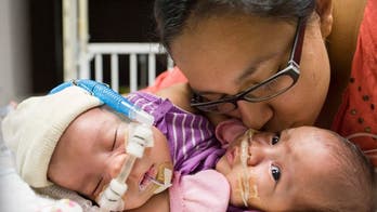 Mother of conjoined twins has ‘hope’ and ‘faith’