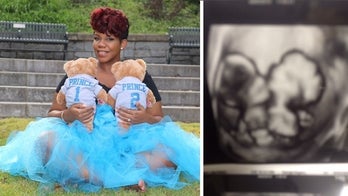 Conjoined twins whose sonogram embrace went viral die, hospital says