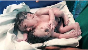 Conjoined twins share everything but brain, spinal cord