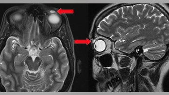 Lost contact found in woman's eyelid 28 years later