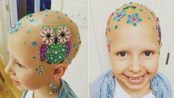 Girl with hair loss condition puts unique twist on 'Crazy Hair Day'