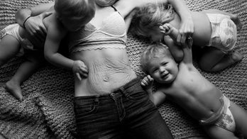 Mom makes powerful statement by posting photo of triplet pregnancy scar