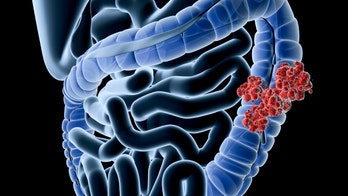 Colorectal cancer rates rise sharply in younger US adults