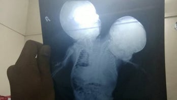 Tears as conjoined twins die day after birth