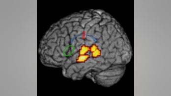 Root causes of dyslexia unraveled
