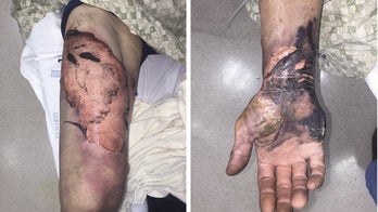 Are e-cig injuries exploding upward?