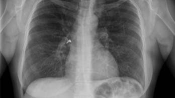 Woman accidentally gets earring stuck in lung after using inhaler