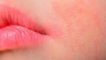 Fitness blogger praised for sharing makeup-free photo after eczema flareup