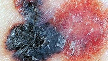 Amgen's melanoma drug shows promise in key trial