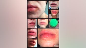 Eos settles lawsuit over rashes, blisters