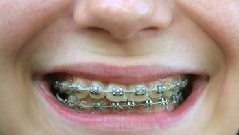 What you should know about the DIY braces trend