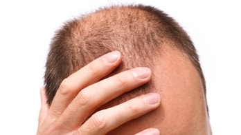 Hair loss drug may cause severe depression
