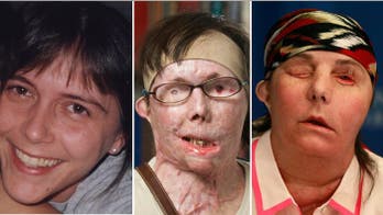 Vermont woman reveals new face after transplant