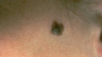 Skin cancer drop in Northeast bucks rising rates elsewhere
