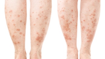 4 skin conditions that can signal other health problems