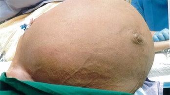Woman has 61-pound mass removed from uterus