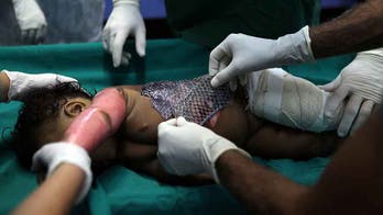 Brazilian doctors use fish skin to treat burn victims, ease the pain