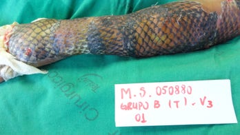 Burn victim covered with fish skin in pioneering new treatment