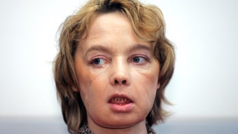 Frenchwoman who received world's 1st face transplant dies
