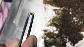 Indian man has nearly 12K stones removed from gallbladder