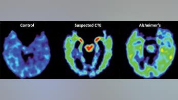 In first, a patient with CTE but no brain injury