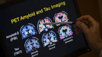 Many people being treated for Alzheimer's may not actually have it