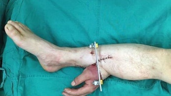 Doctors save man’s hand by grafting it to his leg