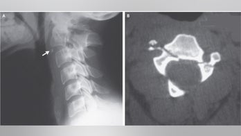 Man survives 'hangman's fracture' after crash