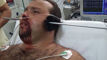 Viral photo shows fisherman's face punctured by spear after freak accident